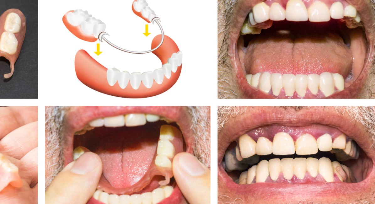 Full Mouth Rehabilitation at Dr Ishita Dental Clinic Viman Nagar Pune